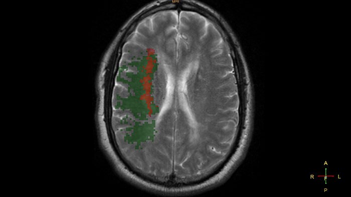 mr t2 neuro