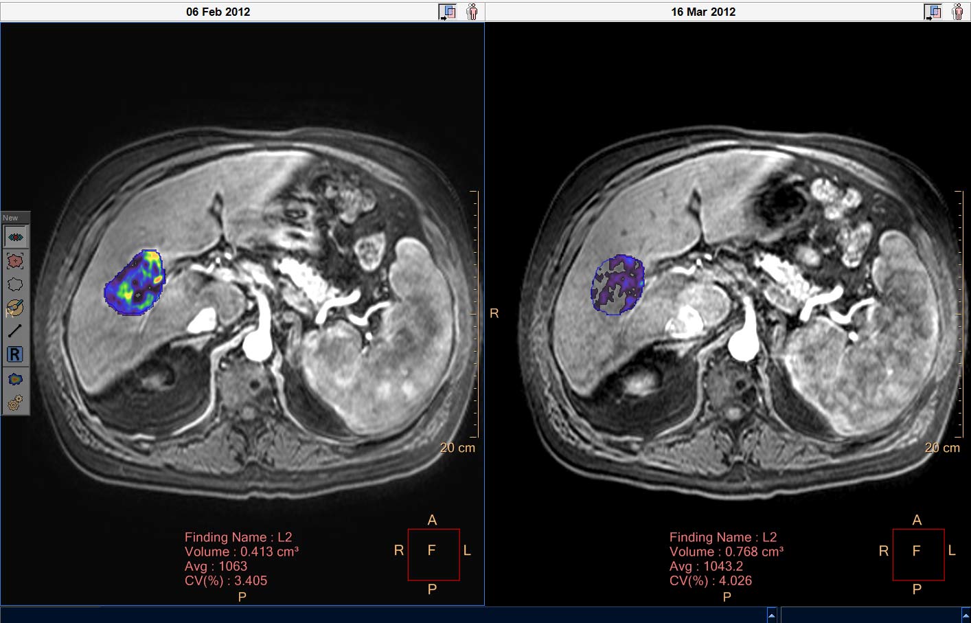 Liver lesion follow-up