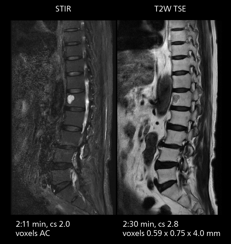 Lumbar spine mri one