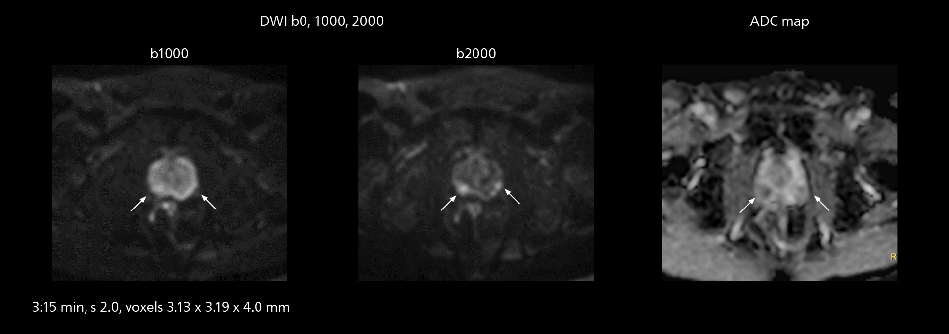 Prostate mri two