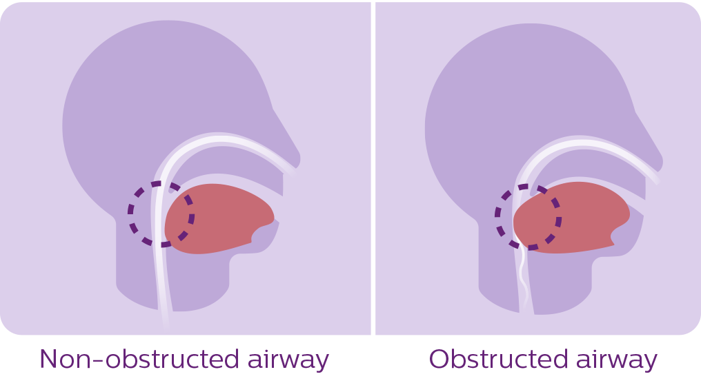 diagram over søvnapnø