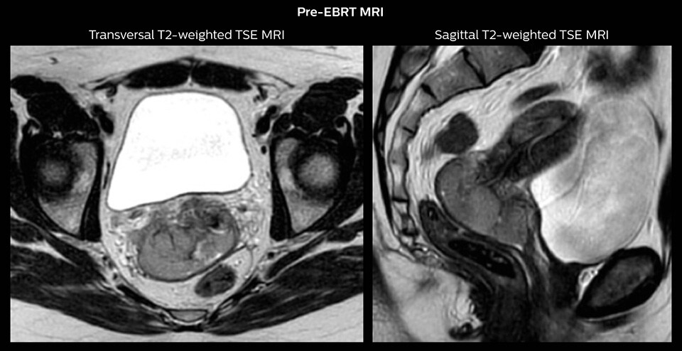 Pre-EBRT MRI Sagittal