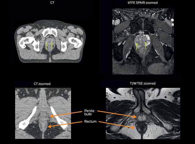 mri of critical structures before prostate radiation therapy