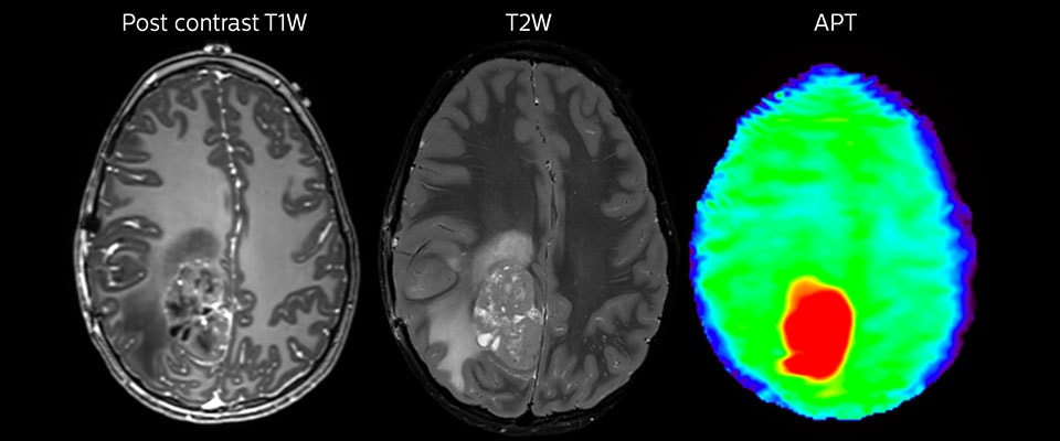 Large metastatic brain lesion