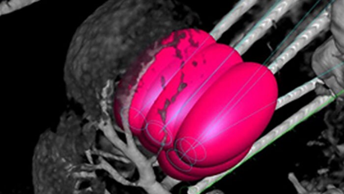 XperGuide ablation