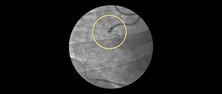 In stent restenosis masthead