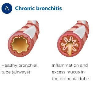 Tværsnit af bronkierne